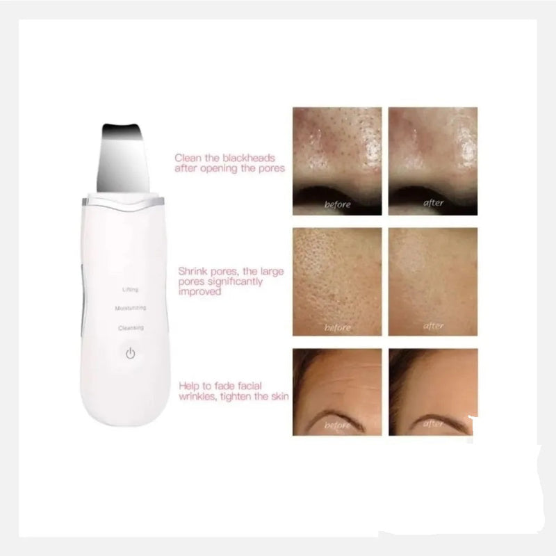 Pala Ultrasónica Facial Depurador Removedor Peeling